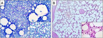 Case report: Rethinking NGS analysis in diagnosing diamond-blackfan anemia syndrome